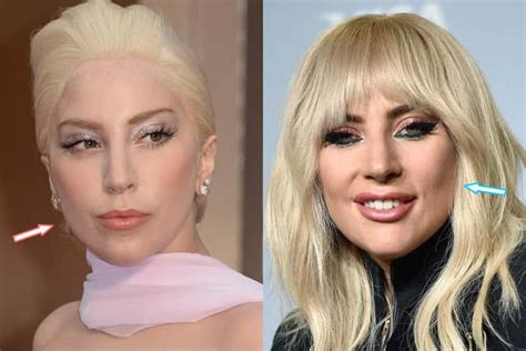 Lady Gaga Plastic Surgery